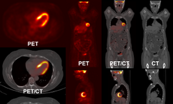 Fly4PET: Fly Algorithm in PET Reconstruction for Radiotherapy Treatment Planning